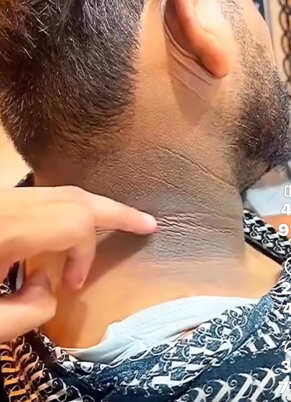 Psoriasis
