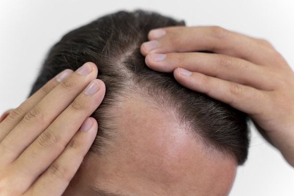 Psoriasis