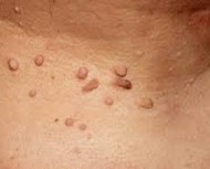 Psoriasis