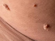 Psoriasis